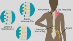 Kemik Hastalıkları (Osteokondritler), Kalça ve Sırt Bölgesindeki Kemik Bozuklukları Sebepleri Tedavisi
